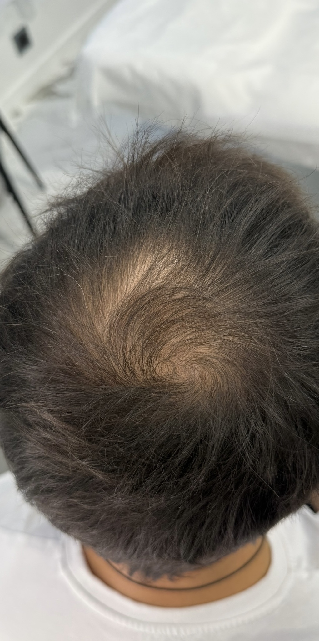 После процедуры Лечение алопеции