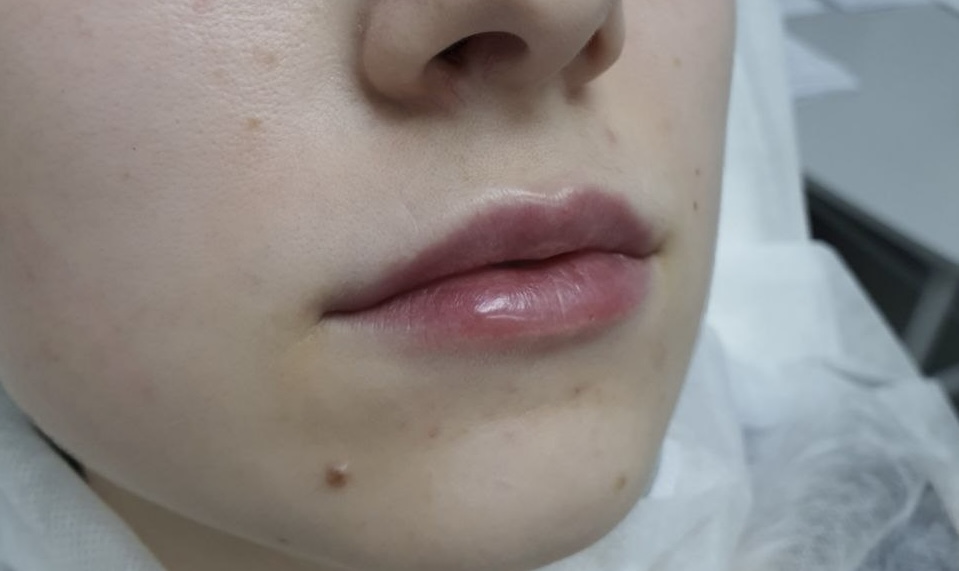 После процедуры Контурная пластика губ
