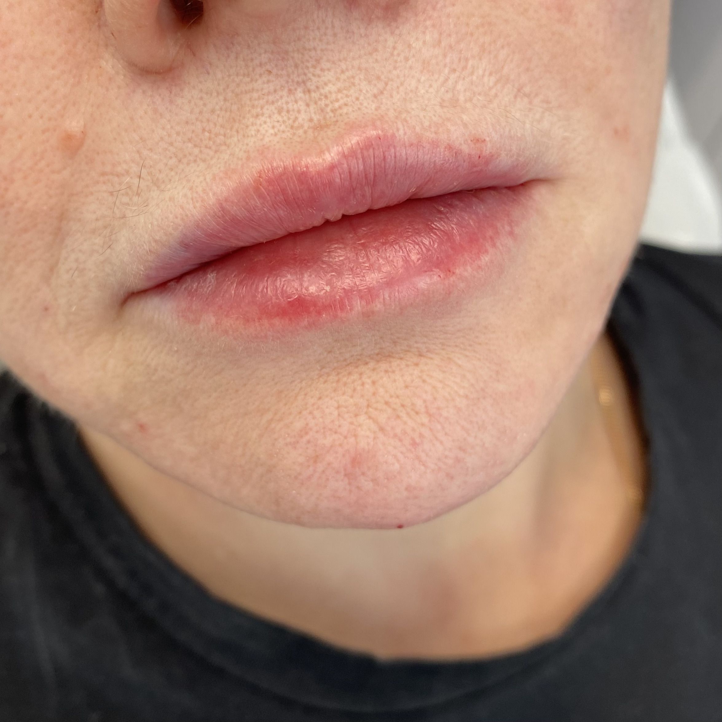 После процедуры Контурная пластика губ