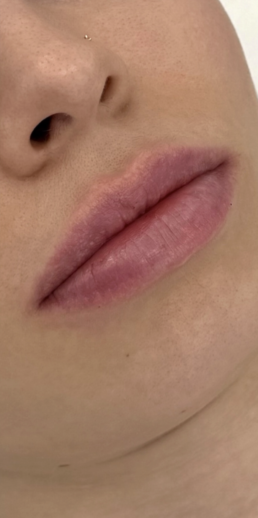 После процедуры Контурная пластика губ