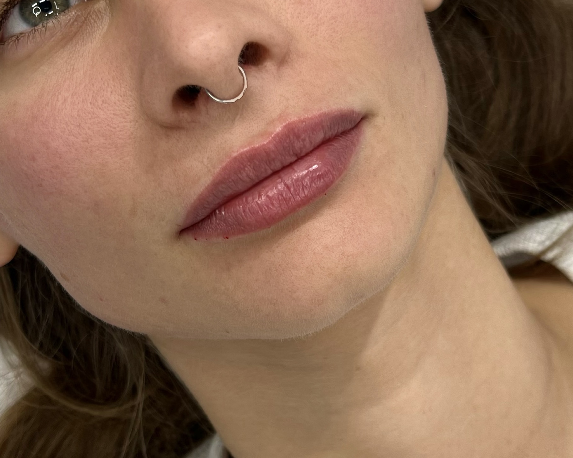 После процедуры Контурная пластика губ