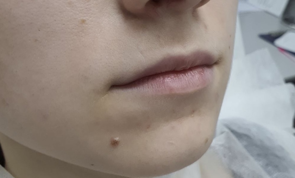 До процедуры Контурная пластика губ