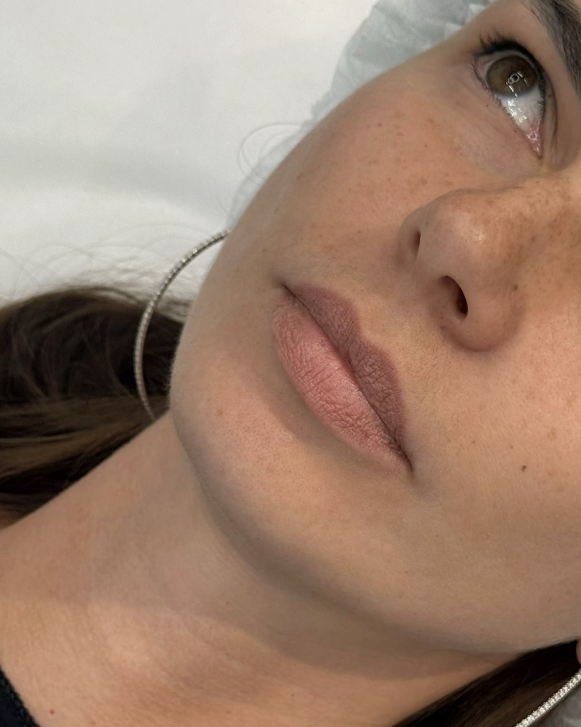 До процедуры Контурная пластика губ