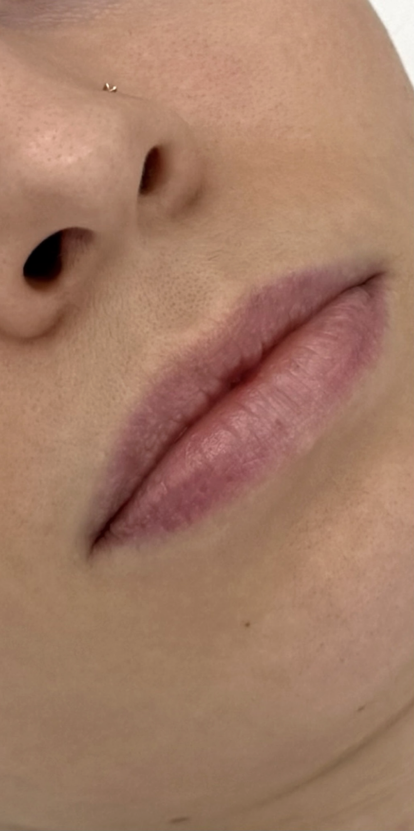 До процедуры Контурная пластика губ